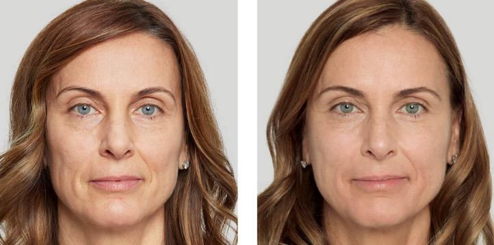 sculptra before and after