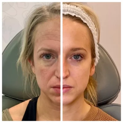 sculptra before and after