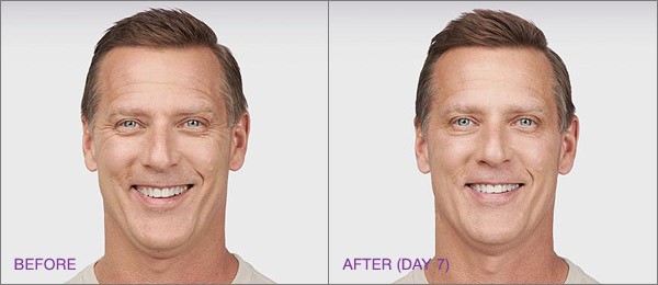 botox for men before and after