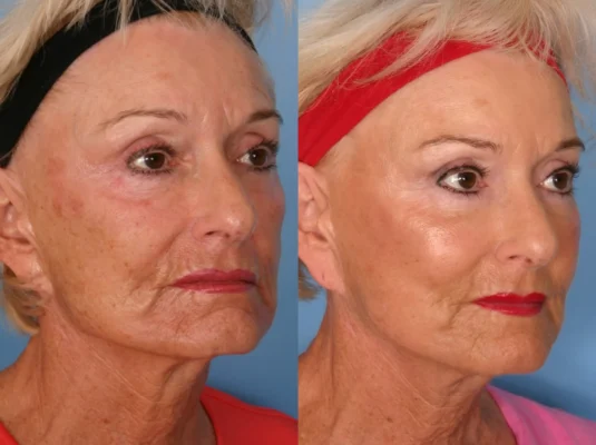 sculptra before and after